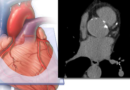 IA revela que la grasa cardíaca predice mejor el riesgo cardiovascular