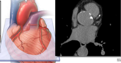 IA revela que la grasa cardíaca predice mejor el riesgo cardiovascular